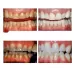 Professional Nano Teeth Whitening Oral Cleansing Set